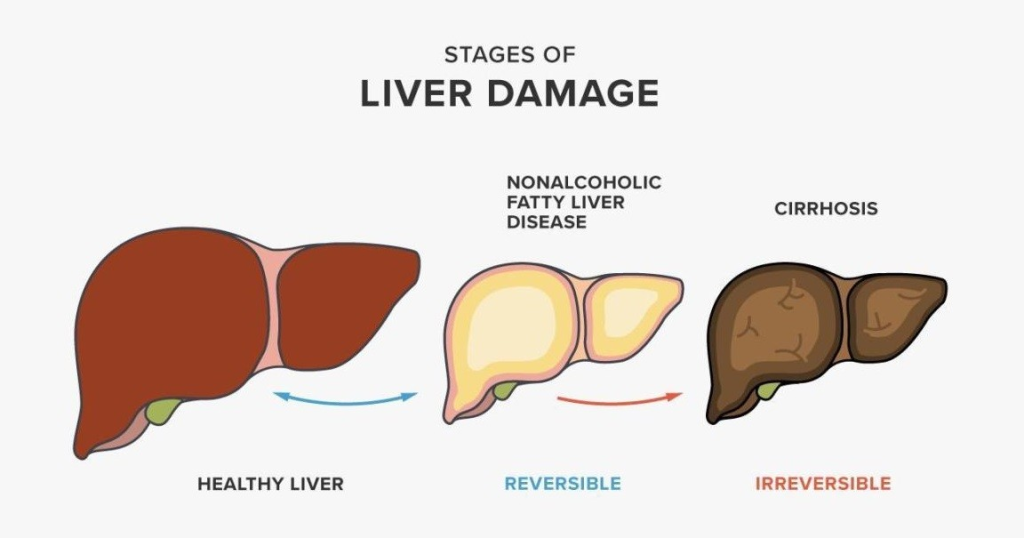 Don't Ignore These Fatty Liver Warning Signs